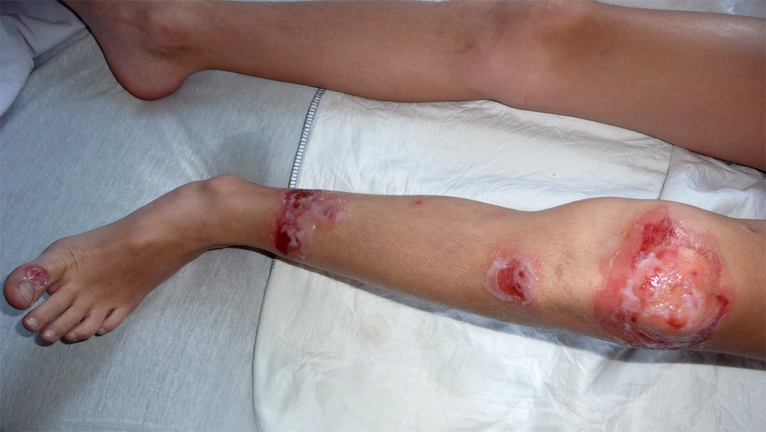 Bulløs impetigo med store væskeblemmer