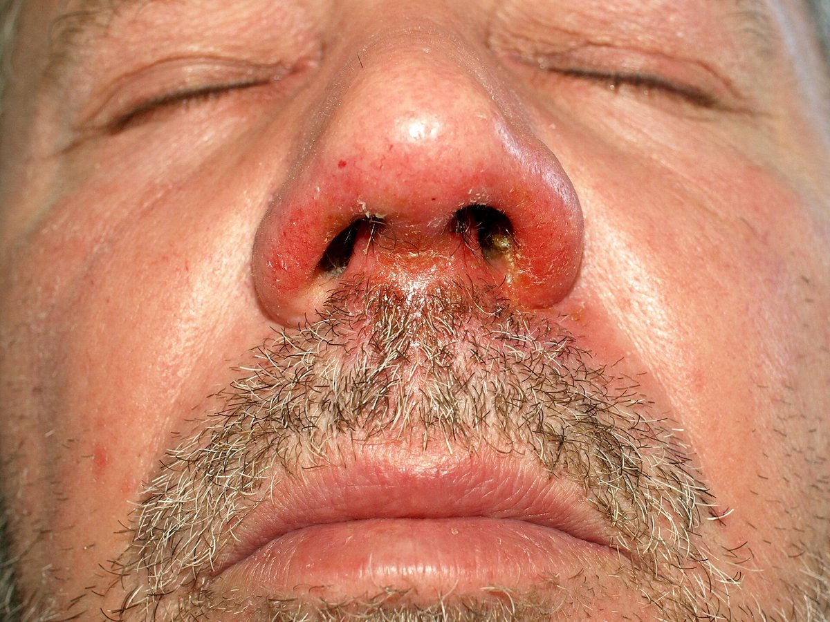 Brannkopper (impetigo) i ansiktet ved nesen